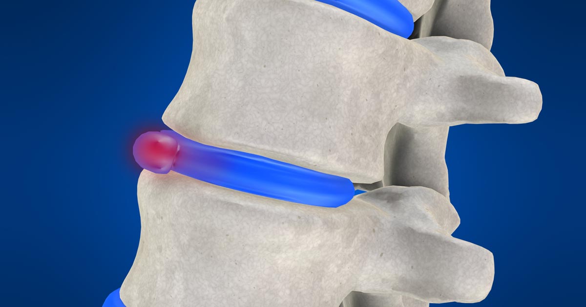 Kettering non-surgical disc herniation treatment