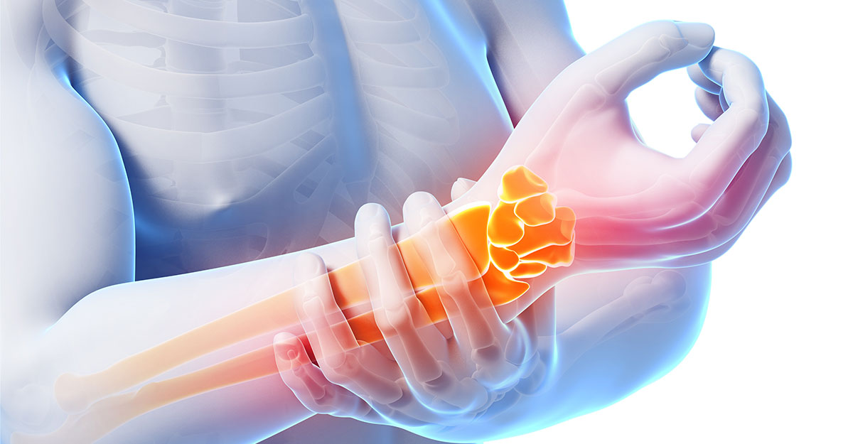 Kettering natural carpal tunnel treatment